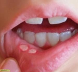 چگونه آفت دهان را درمان کنیم ؟