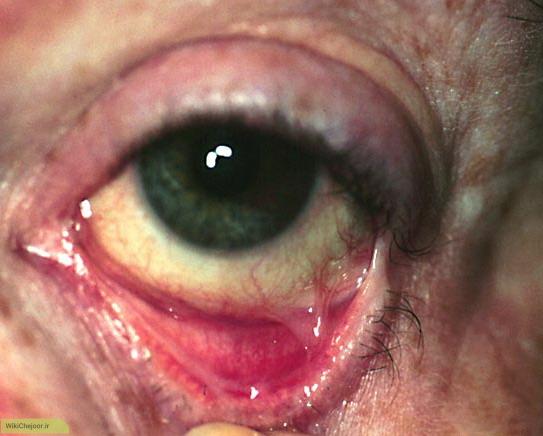 چگونه پنفیگوئید سیکاتریسیل چشمی (OCP) ایجاد می شود؟